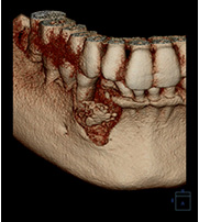 歯周治療の診査・診断