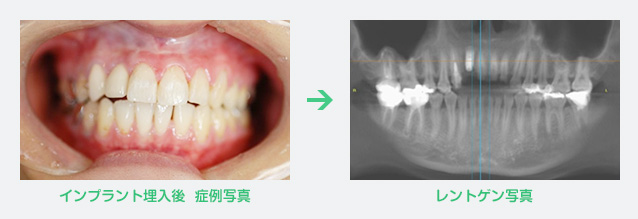 インプラント症例写真